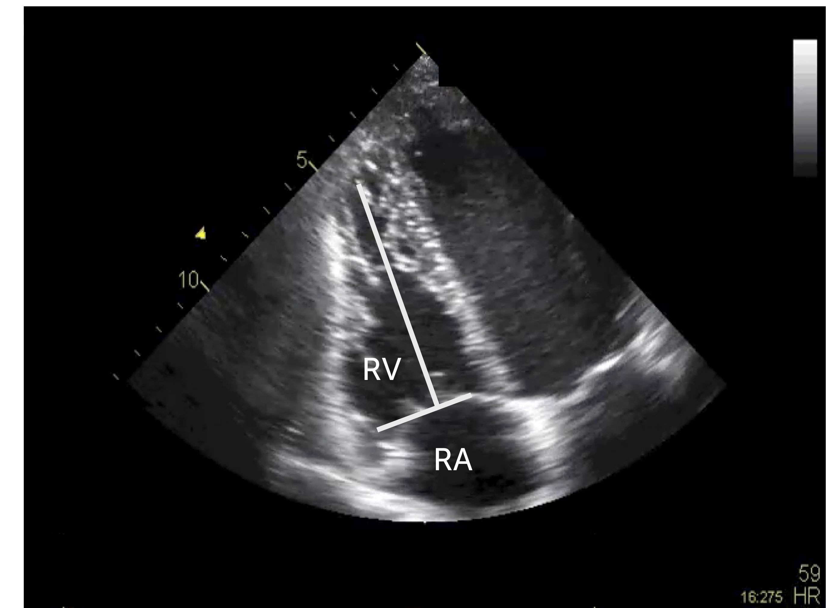 Visual Assessment Of Right Ventricular Function Sonography